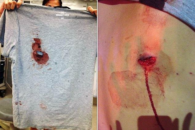 如何治疗枪伤？