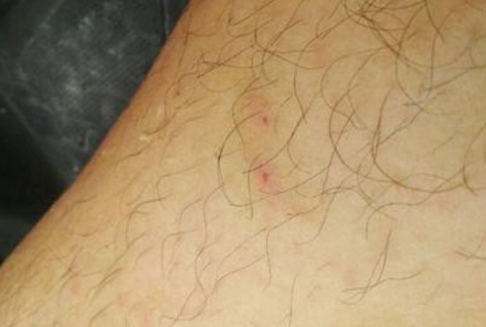 蜈蚣咬伤后，应该如何处理？