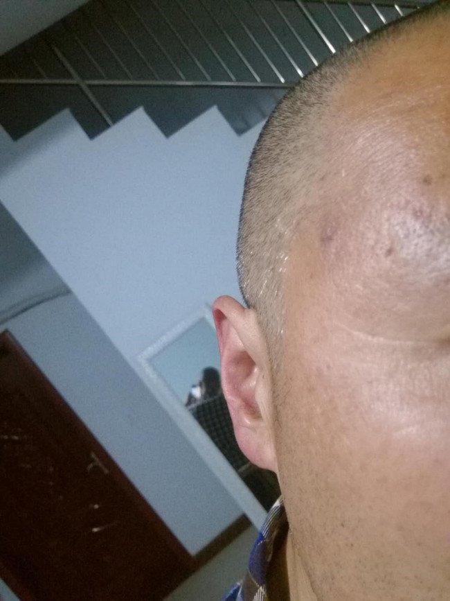 治疗疣的最好方法