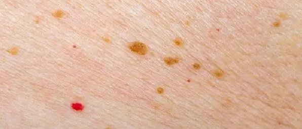 皮肤上有许多小血点