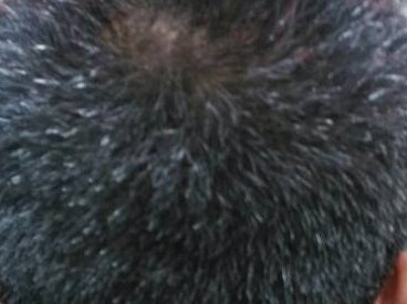 一夜白头真的存在吗，出现的原因是什么？