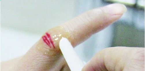 日本液体创可贴怎么弄下来