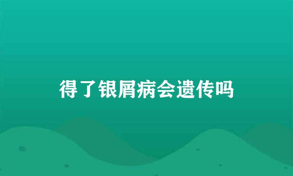 得了银屑病会遗传吗