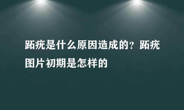 跖疣是什么原因造成的？跖疣图片初期是怎样的